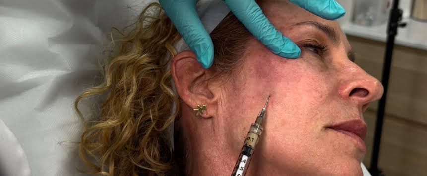What's the Role of PRP Filler in Regenerative Medical Aesthetics? | Perfect  B