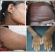 Image result for Ichthyosis