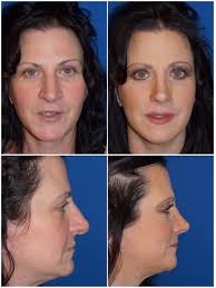 Rhinoplasty Surgery Center of Chattanooga