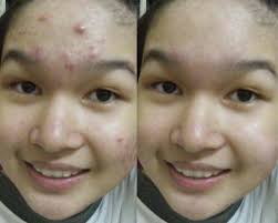 Pilih sabun muka sesuai gender dan jenis kulit wajah anda karna dari sekian sabun muka ada yang cocok dan ada yang tidak, dulu saya banyak paka Cara Menghilangkan Jerawat Dengan Photoshop Artikel Komputer