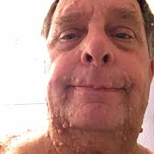 Got drafted in 1971 but was told I'm 4F medically unfit for duty