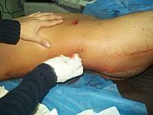 The size, shape, configuration and velocity of the bullet at the . Gunshot Wound Wikipedia