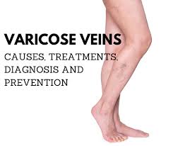 Varicose Veins Causes Treatment Diagnosis And Prevention Elite Vein Clinic