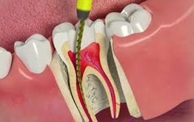 Do i need to take antibiotics after root canal? A Step By Step Guide To Root Canal Treatment