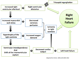 Image result for Right Heart Failure