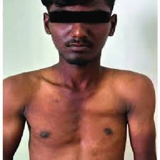 PDF) An Unusual Case of Left-Sided Poland Syndrome Presenting with  Diaphragmatic Hernia and Mediastinal Shift with Absence of Hand and  Scapular Deformity