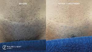We did not find results for: Getting Rid Of Ingrown Hairs With Laser Hair Removal Youtube