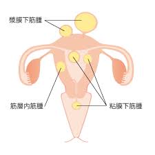 Doujin music | 同人音楽 8 янв 2015 в 18:38. å­å®®ç­‹è…«ã®åˆ†é¡ž å­å®®ç­‹è…«ã‚'çŸ¥ã‚‹ å­å®®ç­‹è…«note