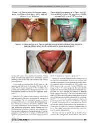 Fournier's gangrene is a urological emergency with a high mortality rate despite advances in the medical and surgical fields. Fournier S Gangrene