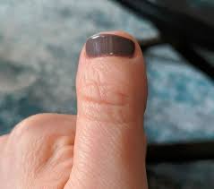Hello, is there a cosmetic procedure for clubbed and stubby thumbs (brachydactyly type d thumbs). What Are Clubbed Thumbs