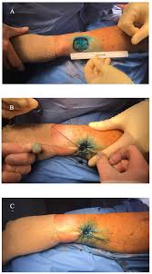 Image result for Purse String Suture