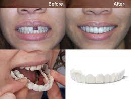 They are created by taking a dental impression of your teeth and using this impression to make a unique set of covers. Snap On Smile Review News Dentagama