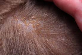 Ci possono essere dei disturbi tricologici: Crosta Lattea Cause E Trattamenti Mamma Sto Bene