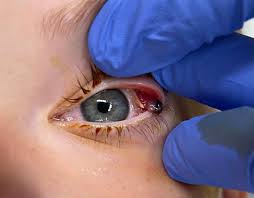 Image result for Eye Foreign Body