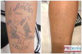 We love to see the progress we're able to make in removing our the number of treatments needed to completely remove the tattoo varies drastically depending on the type of ink used, the depth of the ink, colors in. Leg Feet Laser Tattoo Removal Before After Results Medermis