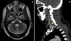 Carotid artery surgery is done to restore proper blood flow to the brain. Ultrasound During Neck Rotation To Reveal A Case Of Positional Occlusion Of The Internal Carotid Artery Springerlink