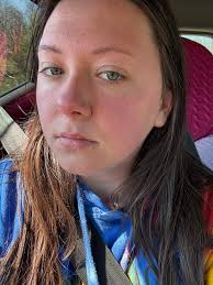 Can we color our hair if we have pityriasis rosea