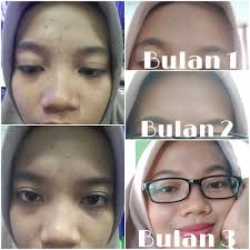 We did not find results for: Theraskin Skincare Acne Wash Review Female Daily