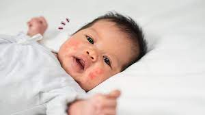 Maybe you would like to learn more about one of these? 15 Jenis Bintik Merah Pada Bayi Mulai Dari Ringan Hingga Beresiko Orami