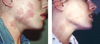 Birthmark Removal Treatment Melbourne