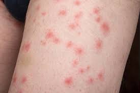 Image result for bedbugs bites
