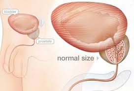 The quickest answer is yes! Enlarged Prostate Bph Symptoms Diagnosis Treatment