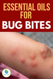 Allergic Reaction Black Ant Bites Pictures Top 7 Essential Oils For Bug Bites Essential Oils For Mosquitoes Essential Oils Bug Bites Best Essential Oils