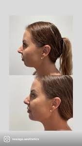 1ml of CHIN FILLER...