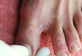 The skin under, at the front and between my toes are not showing any signs of athletes foot or any other condition. Pictures Of Skin Diseases And Problems Athlete S Foot