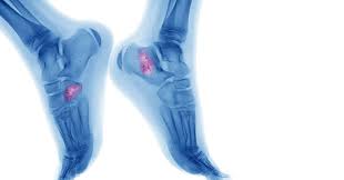 Primary bone cancer develops in the bones. Ankle Cancer Bone Cancer Usually Affects The Long Bones That Make Up Arms And Legs