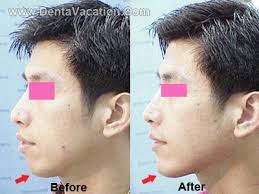 We did not find results for: Corrective Jaw Surgery In Tijuana Mexico