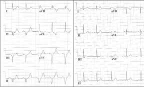 Echocardiogram both acute and chronic myocarditis is associated with reduced systolic function. Sample Ecgs From A 15 Year Old Female Patient With Myocarditis The Download Scientific Diagram