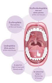 Image result for gum cancer symptoms