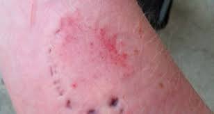 Image result for Human Bite