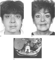 Syndromes of Corticosteroid Excess
