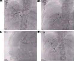The blood vessel that carries blood from gut to the liver : Hepatic Portal Vein An Overview Sciencedirect Topics