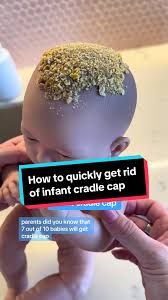 Image result for white scabs on the head in children