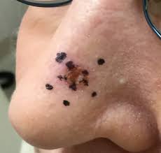 Image result for skin cancer on nose pimple