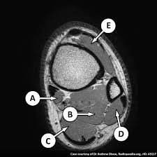 This presentation is the first series of the mr imaging of knee. Soleus Muscle Radiology Reference Article Radiopaedia Org