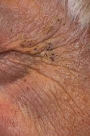 The disease was originally described in 1932 by favre 1. Favre Racouchot Syndrome Doccheck