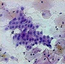 En effet le nombre de cellules à analyser peut être trop faible pour permettre une interprétation fiable, ou bien il peut le médecin qui interpréte le frottis peut donc être amené à demander d'effectuer un nouveau prélevement, éventuellement après un court. Savoir Interpreter Un Frottis Miss Frottis