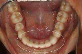 Why do orthodontists recommend permanent retainers? How To Get Rid Of The Pain That Permanent Retainer Is Causing As The Wire Came Off From One End Quora