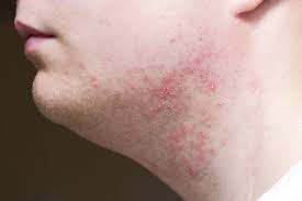 Razor Bumps And Razor Burn? What Causes It? The Wet Shaving Club
