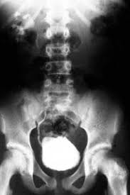 Image result for Voiding Cystourethrogram