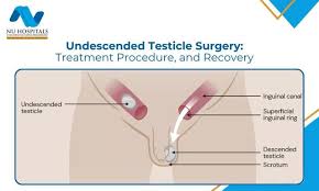 Image result for Undescended Testicle