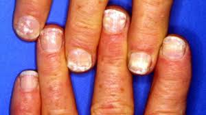 White Spots on the Nails: Causes and More