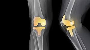 After you have a total knee replacement, one of your main goals is to regain the range of motion at your range of motion refers to how far and in which directions you're able to move your knee sit up tall on the edge of a bed or firm surface with your thighs supported and your foot resting on the floor. Knee Replacement Surgery Overview