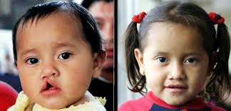 Operation Smile Alumni