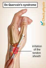 Educational image placeholder: postpartum thumb and wrist strain related to De Quervain's