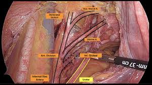 Introduction the anatomical basis of pelvic floor function in normal and abnormal states pelvic floor ultrasound: Pelvic Anatomy Unedited Internal Iliac Artery Radical Hysterectomy Ureter And Its Relations Youtube